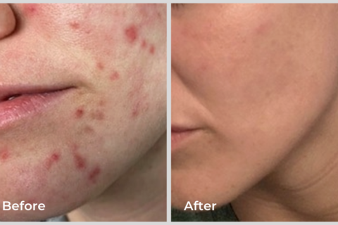 Before and after Spectrum’s IPL and Erbium laser treatments